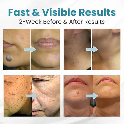 Xorita Wart Remover