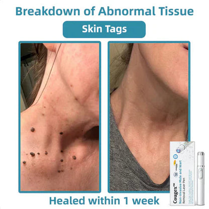 Xorita Wart Remover