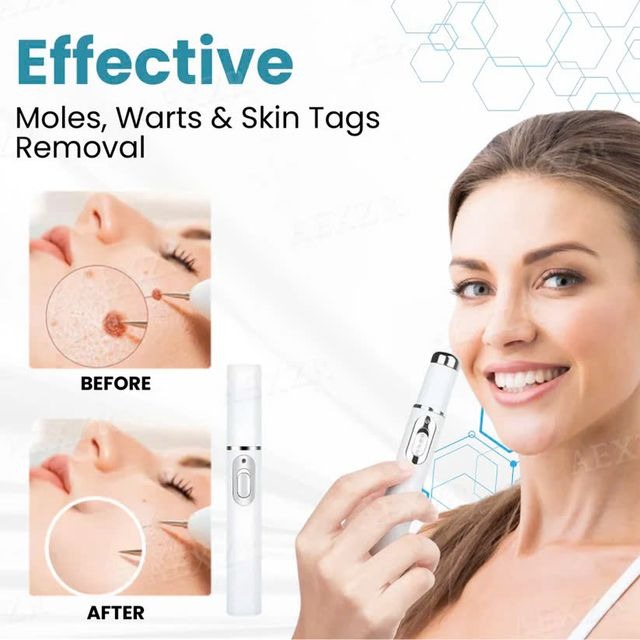 Xorita Wart Remover